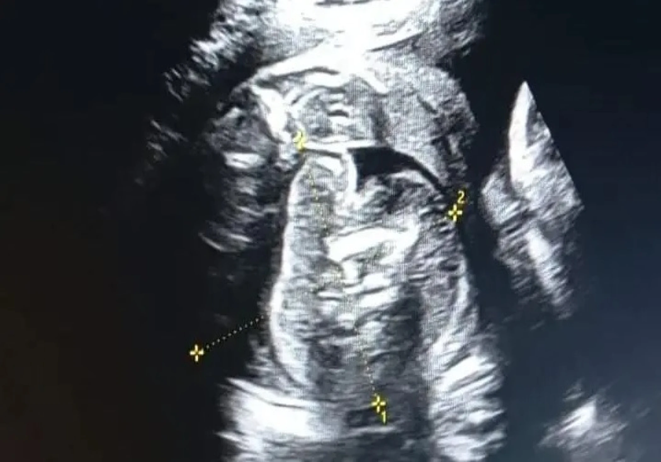 A baby in a woman's belly and a baby in a baby's belly; what exactly is this?